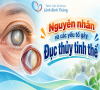 Nguyên nhân và các yếu tố gây Đục thủy tinh thể